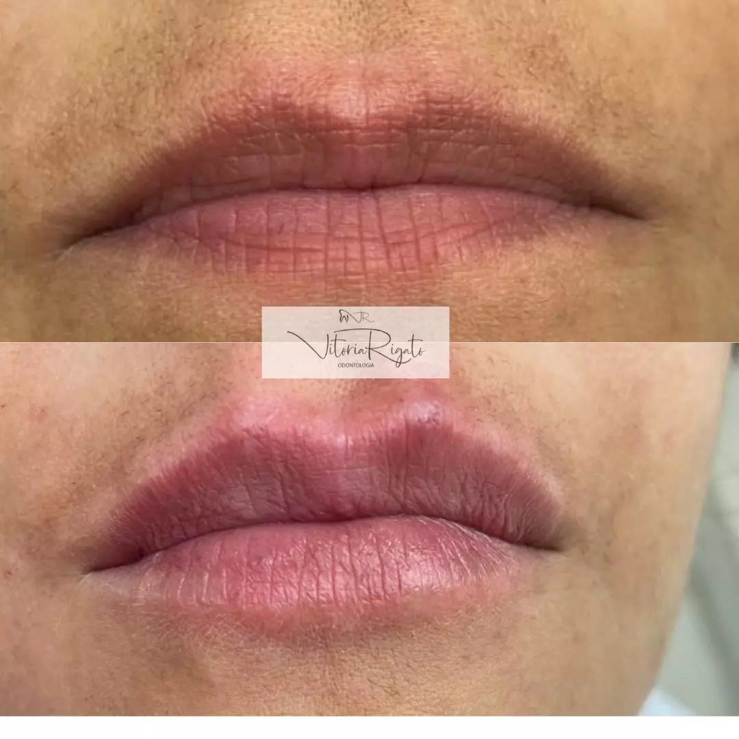 Harmonização e Preenchimento Labial (antes e depois)
